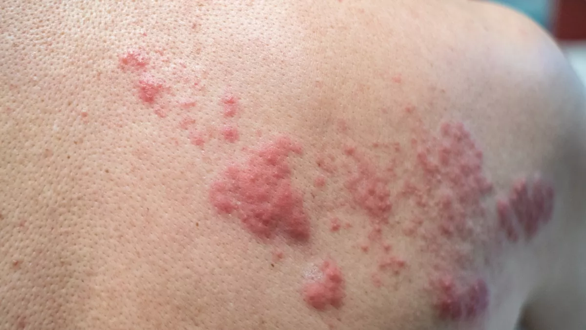 Shingles Can Cause Severe Pain Complications: Doctor Reveals Real Case